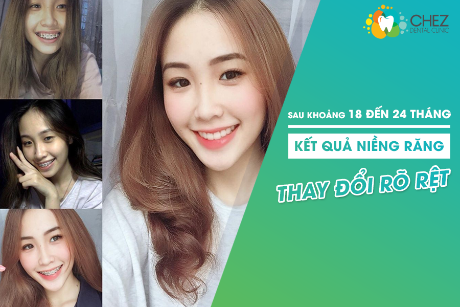 Kết quả sau khi niềng răng