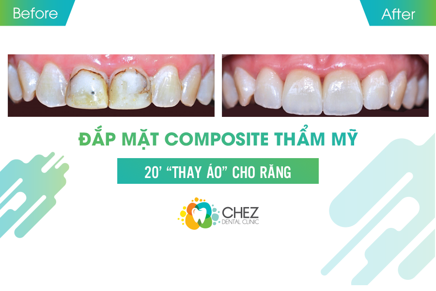 Khách hàng khi đắp mặt composite tại nha khoa Chez!
