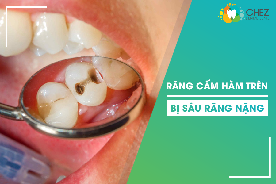 Răng cấm hàm trên bị sâu nặng