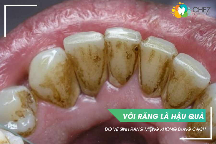 Vôi răng là hậu quả do vệ sinh răng miệng không đúng cách
