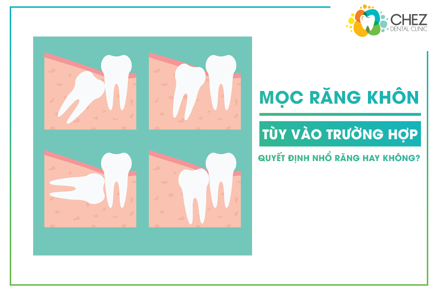 Có nhổ răng khôn hay không còn tùy vào từng trường hợp