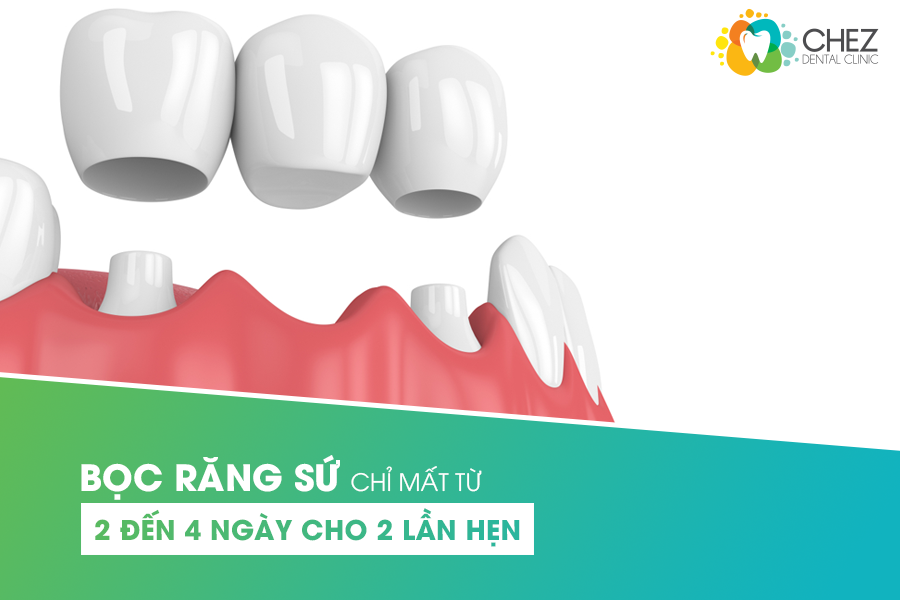 Bọc răng sứ thời gian bao lâu?