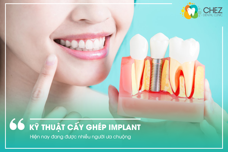 Kỹ thuật cấy ghép Implant