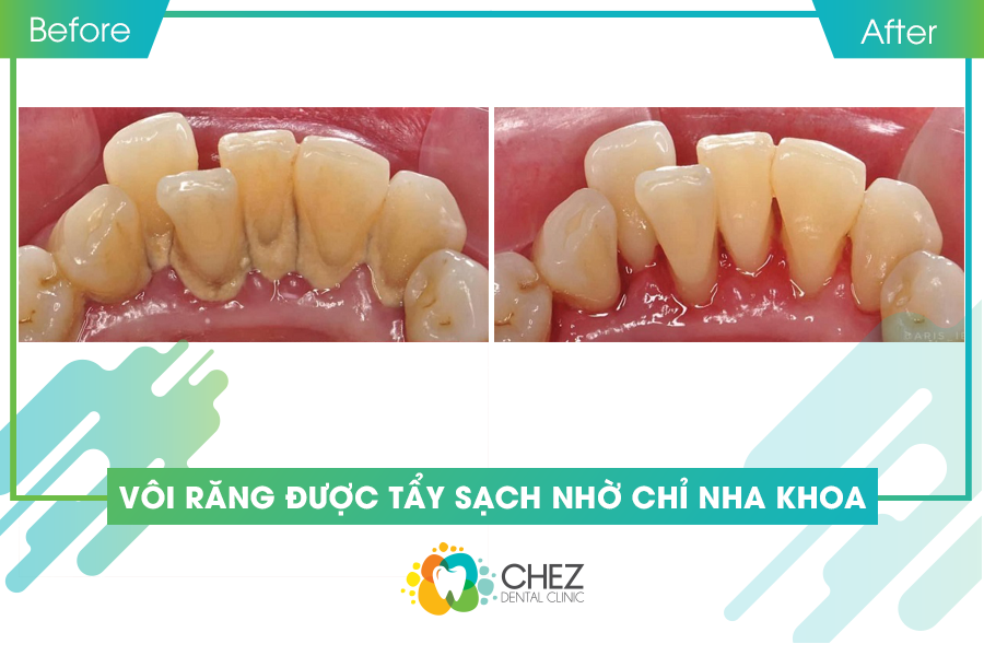 Vôi răng được tẩy sạch nhờ chỉ nha khoa