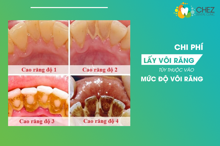 Chi phí lấy vôi răng tuỳ thuộc vào mức độ vôi răng
