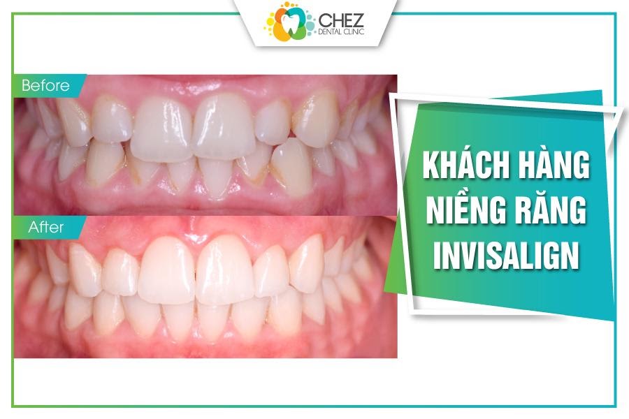 Khách hàng niềng răng Invisalign