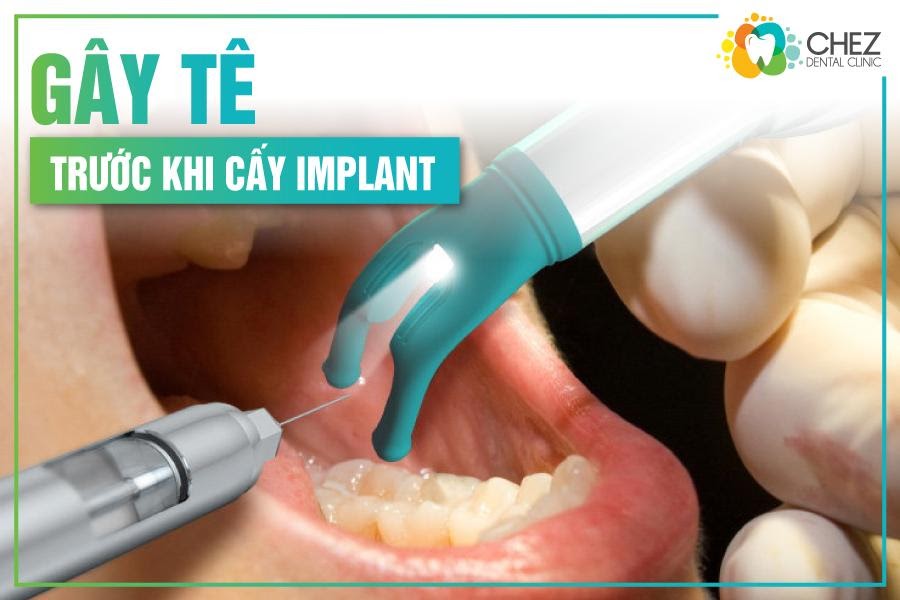 Trước khi làm Implant sẽ được gây mê, giúp giảm đau