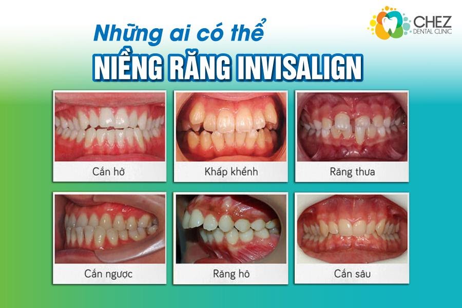 Những ai có thể niềng răng Invisalign?