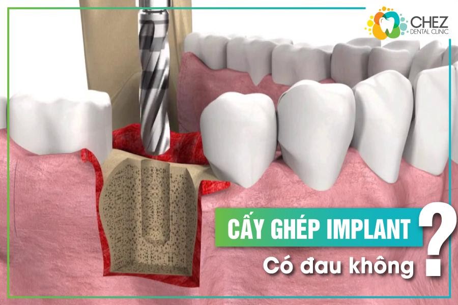 Cấy ghép implant có đau không?