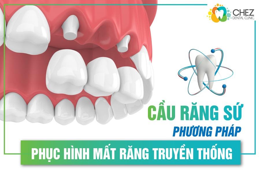 Cầu răng sứ - phương pháp phục hình mất răng truyền thống