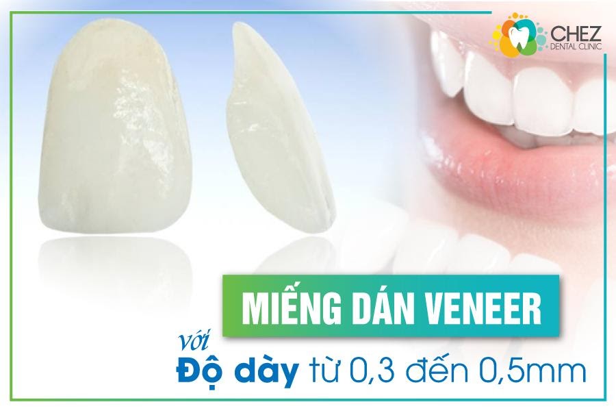 Miếng dán Veneer với độ dày 0,3 đến 0,5mm