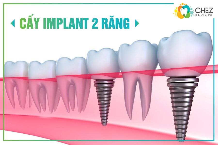 Cấy ghép Implant cho tình trạng mất nhiều răng sẽ Cấy ghép 2 răng implant và phục hình 2 răng sứ.