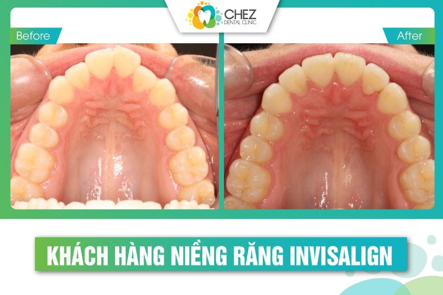 Khách hàng niềng răng invisalign tại Chez Dental Clinic