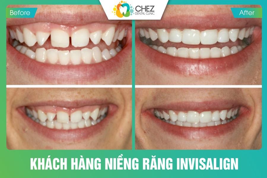 Khách hàng niềng răng Invisalign