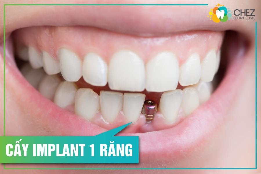Cấy ghép Implant cho tình trạng mất 1 răng sẽ sử dụng 1 trụ implant và phục hình 1 răng sứ.