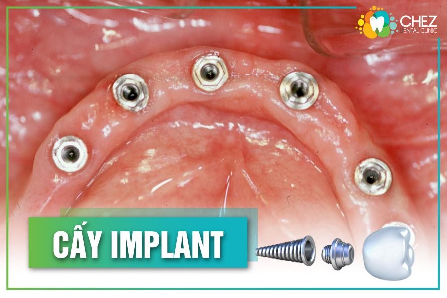 Cấy ghép Implant cho tình trạng mất răng toàn hàm