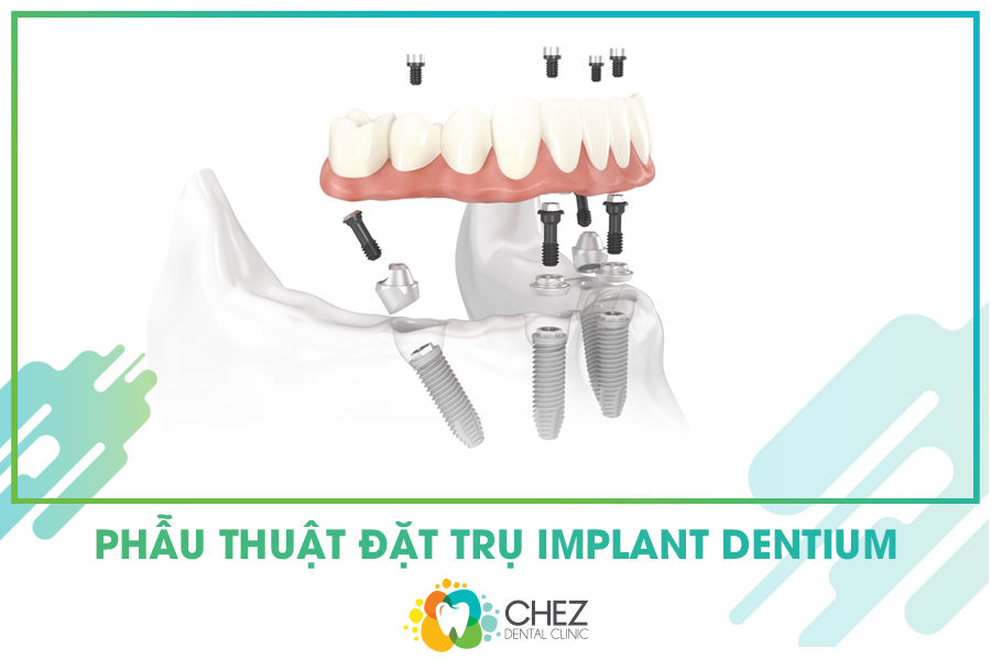 Phẫu thuật đặt trụ Implant Dentium - “Hồi sinh” răng cao thế thế kỷ 21