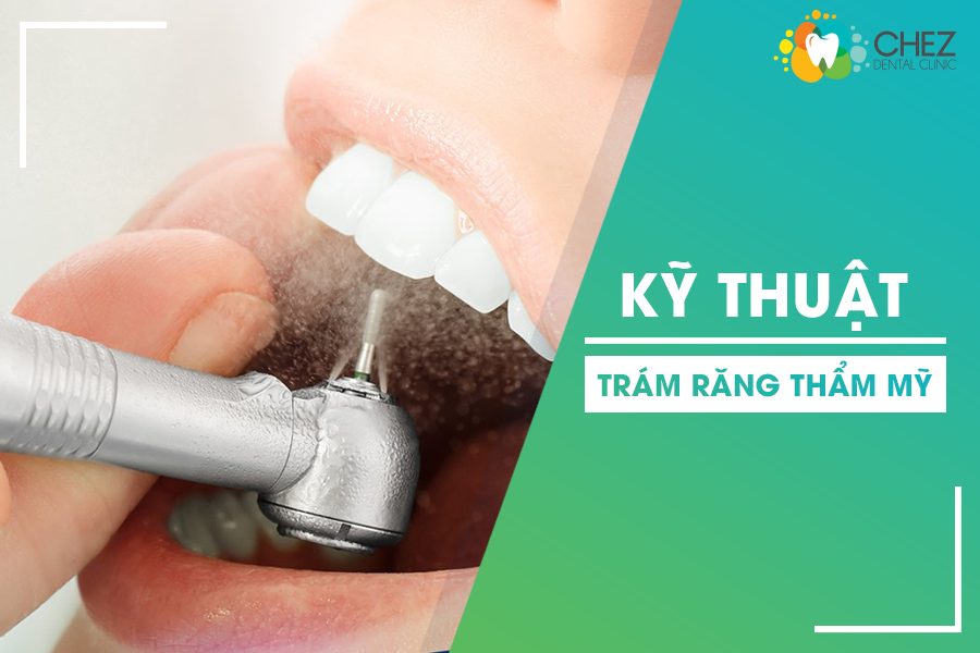 Kỹ thuật trám răng thẩm mỹ