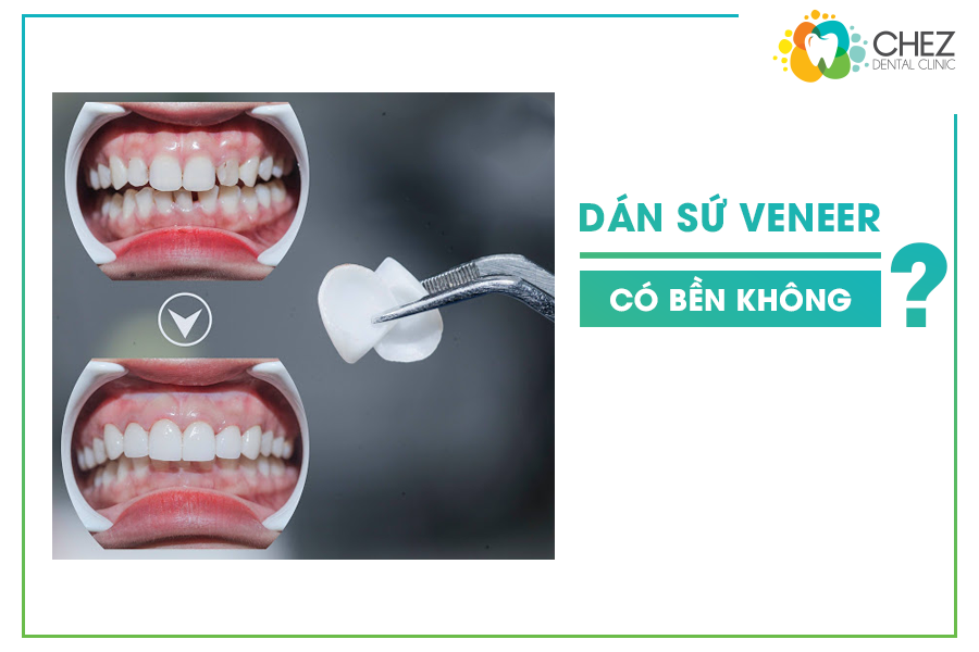 Dán sứ Veneer có bền không?