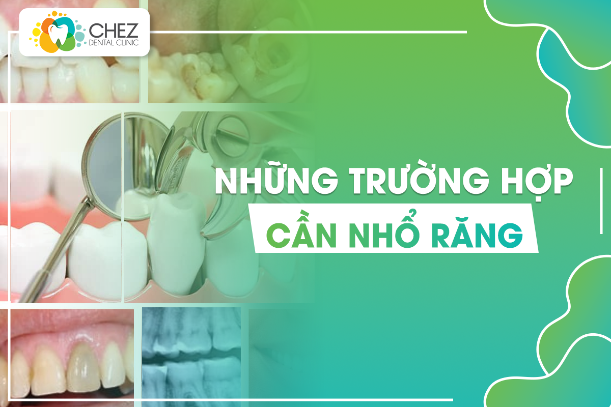 những trường hợp cần nhổ răng