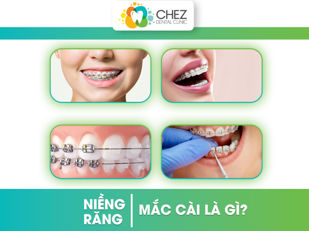 Niềng răng mắc cài là gì?