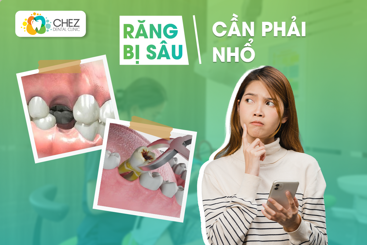 răng bị sâu cần phải nhổ