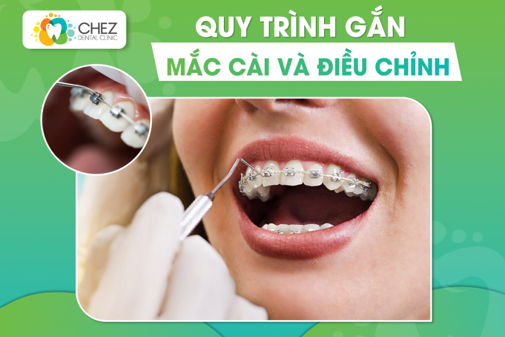 Quy trình gắn mắc cài và điều chỉnh