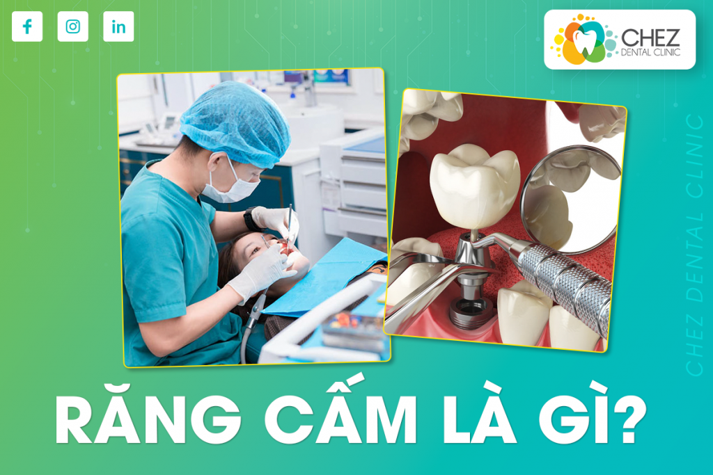 RĂNG CẤM LÀ RĂNG GÌ?