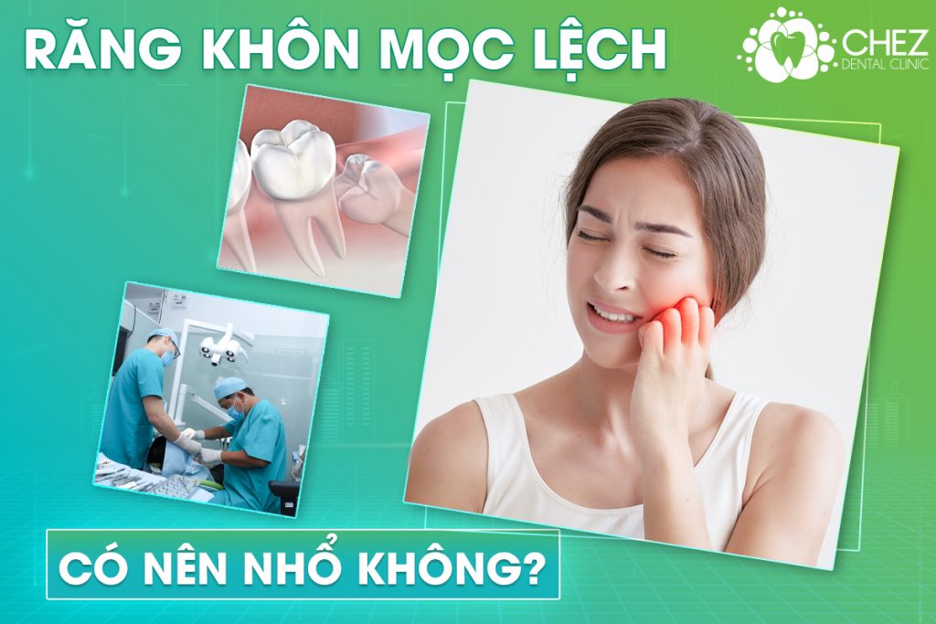 RĂNG KHÔN MỌC LỆCH CÓ NÊN NHỔ KHÔNG?