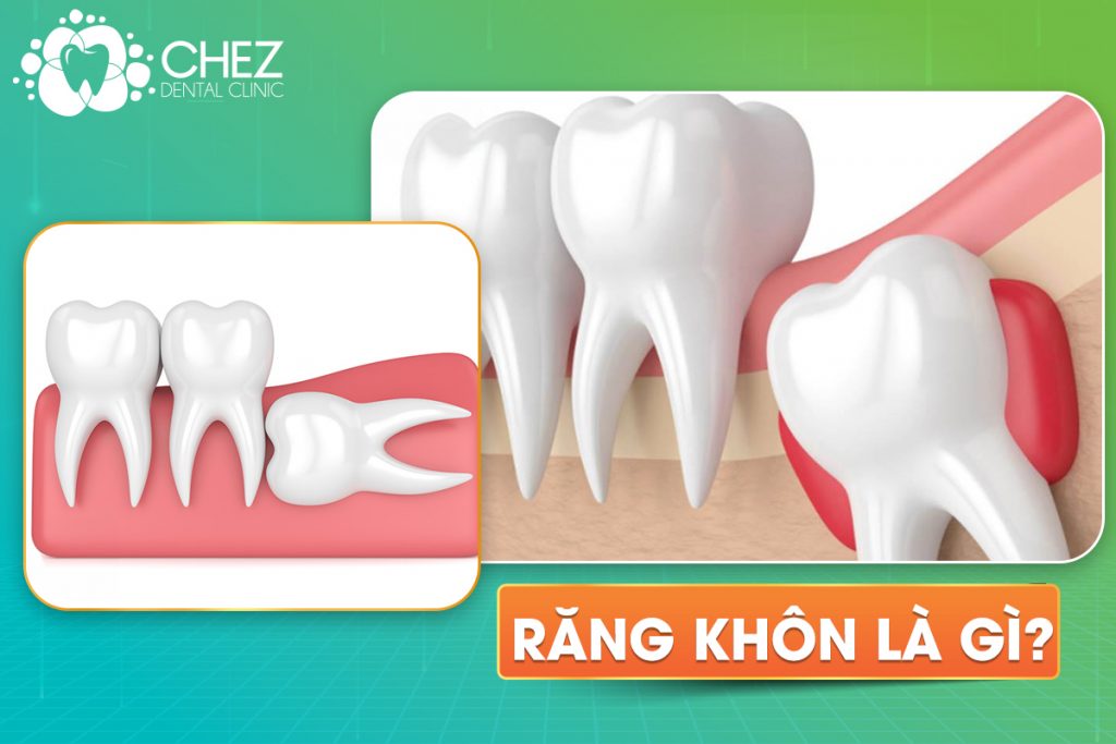 RĂNG KHÔN LÀ GÌ?