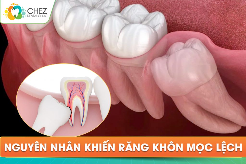 NGUYÊN NHÂN KHIẾN RĂNG KHÔN MỌC LỆCH