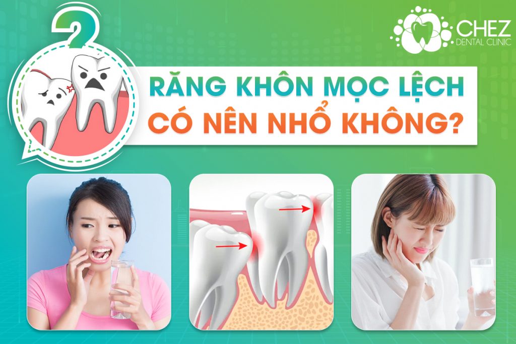 RĂNG KHÔN MỌC LỆCH CÓ NÊN NHỔ KHÔNG?